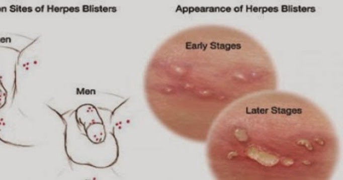 Tindakan pencegahan agar terhindar dari Penyakit Herpes genitalis