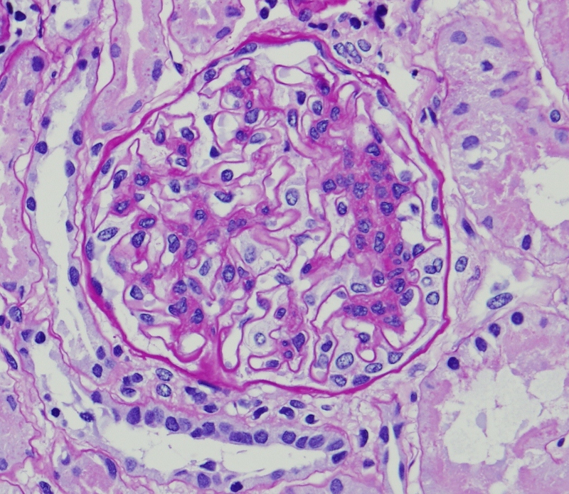 Glomerulonephritis, Iga; Berger Disease; Immunoglobulin A Nephropathy