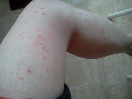 Bedbug Spray