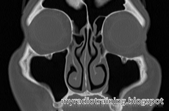 Radiology info hub: Normal Variants: Paranasal Sinuses