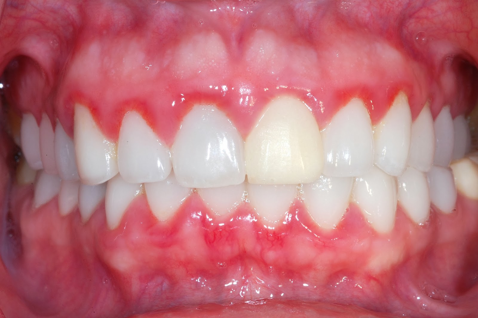 牙龈浆细胞肉芽肿 1 例