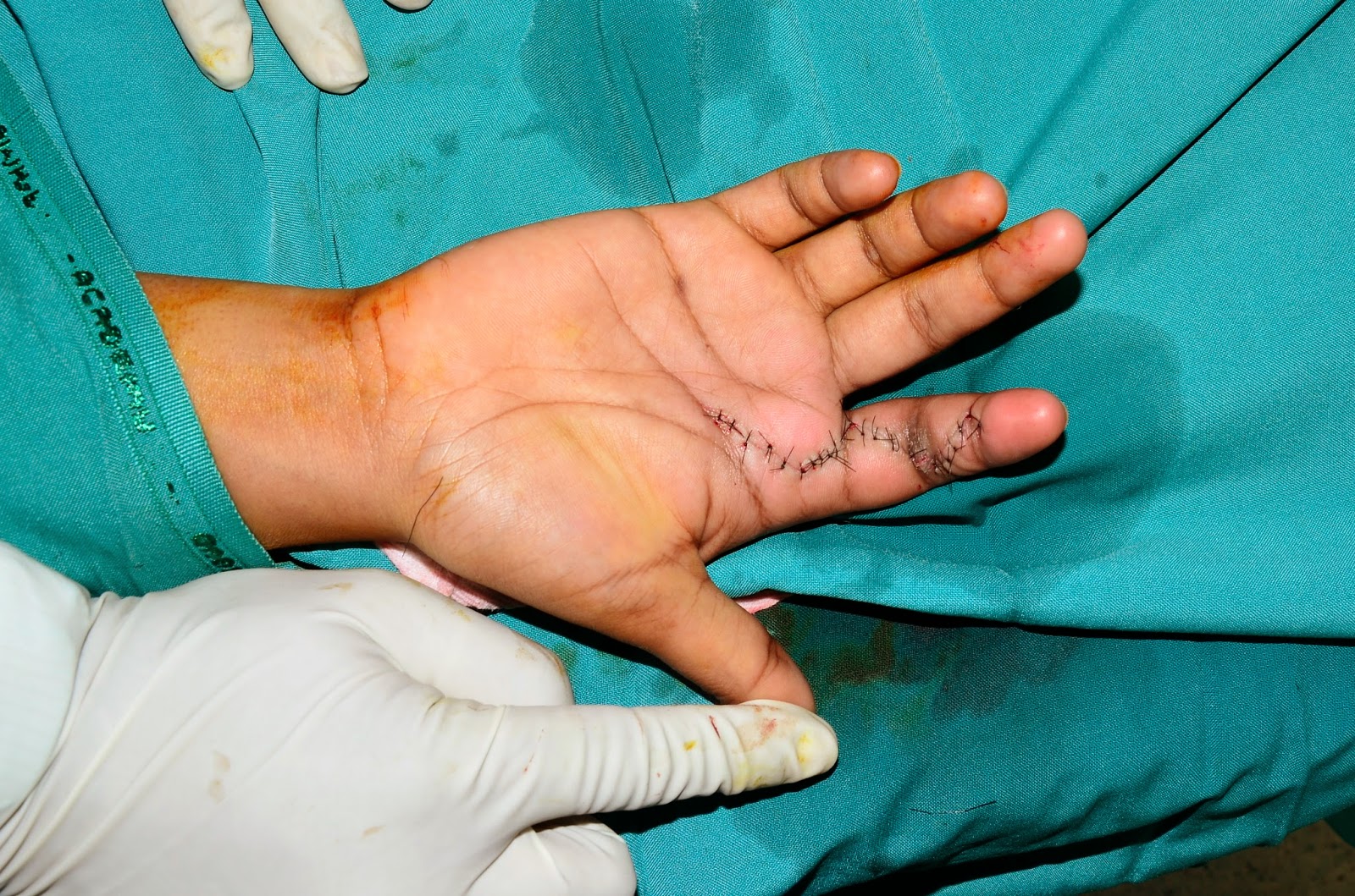 CRUSH INJURIES OF HAND AND UPPER LIMB INJURIES TWO MONTH OLD FLEXOR