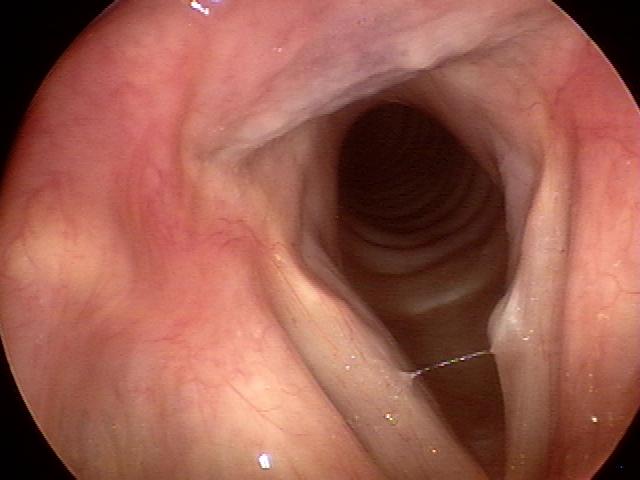 Cyst Nose