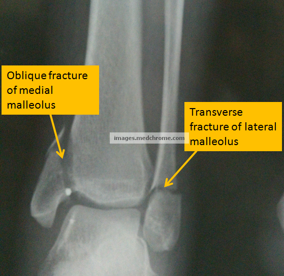 bimalleolar ankle fracture surgery bimalleolar ankle fracture surgery