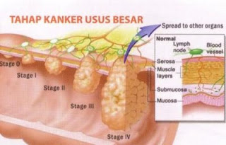 Kanker+Usus.jpg