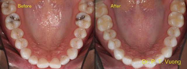 cavities holes fillings cavity teeth wisdom before close vuong phuoc dr finished dmd dentist phil ms