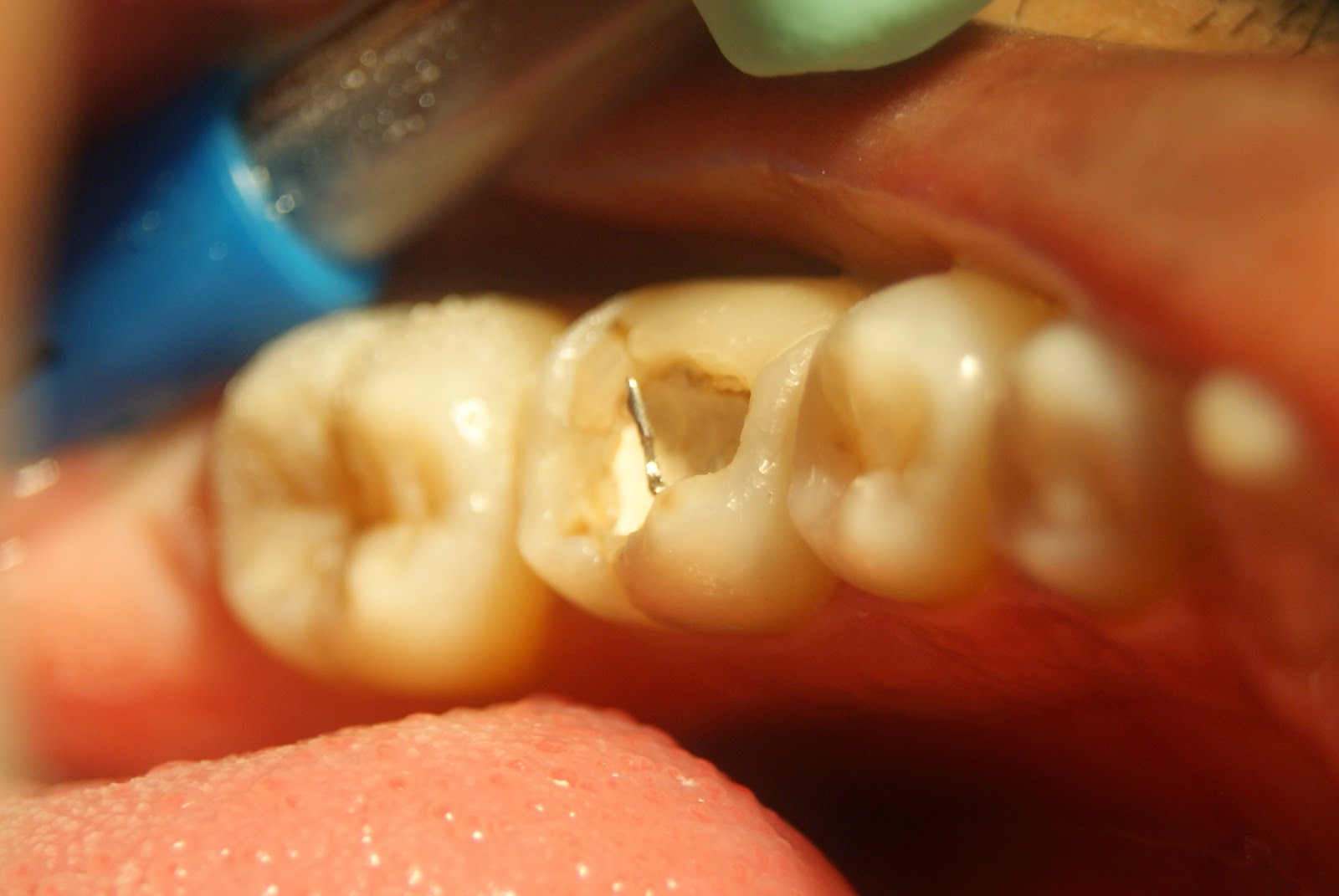 Malas Restauraciones Dentales Restauraciones Dentales