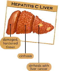 HEPATITIS C