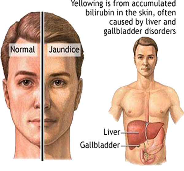 المتوحدون ما هي متلازمة جيلبرت Gilbert Syndrome