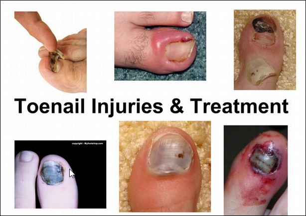 Dr. Pelto's Blog: Presentation about toenail trauma and injury