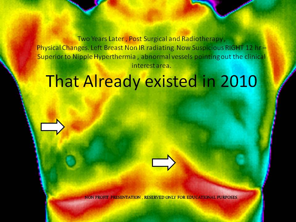 The Breast Thermography Journal (Digital Infrared Analysis) "Breast