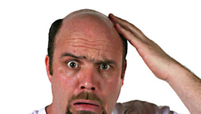 MALE PATTERN BALDNESS - ARE YOU ONE OF THE SUFFERERS?