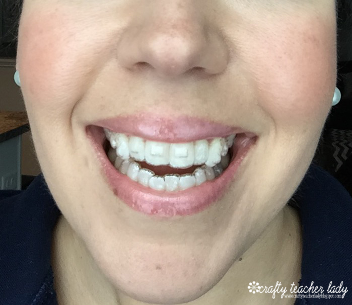 Crafty Teacher Lady The Invisalign Experience