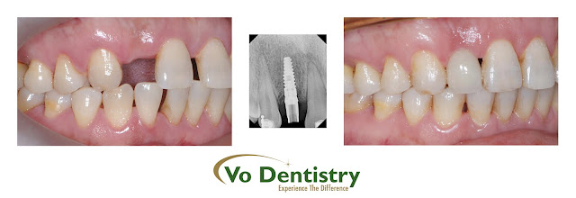 dental implant Lawrenceville Ga 30043, Dacula 30019, Buford,Duluth