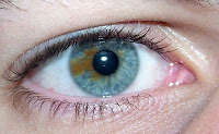 heterochromia sectoral causes types central eyes eye
