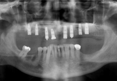 Full Mouth Xray showing Implants