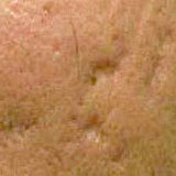 Acne Old Scars, Big Deep Holes, Boxcar acne scars, Icepick acne scars