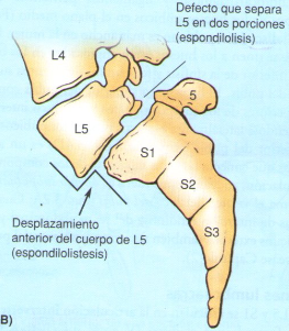 La osteocondrosis de 2-3 grados del departamento de pecho