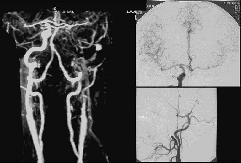 Taysir assistance الإسعاف الطبي تيسير Dissection traumatique de la carotide interne gauche