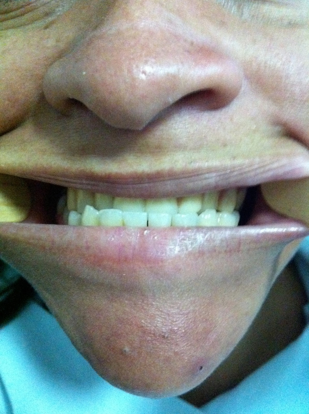Relações maxila e mandíbula em dentados