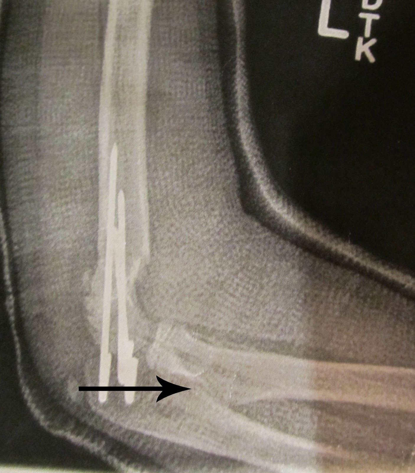 life with 4 kiddos broken bones