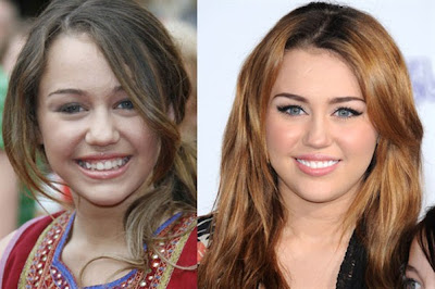 cambio sonrisa actrices famosas