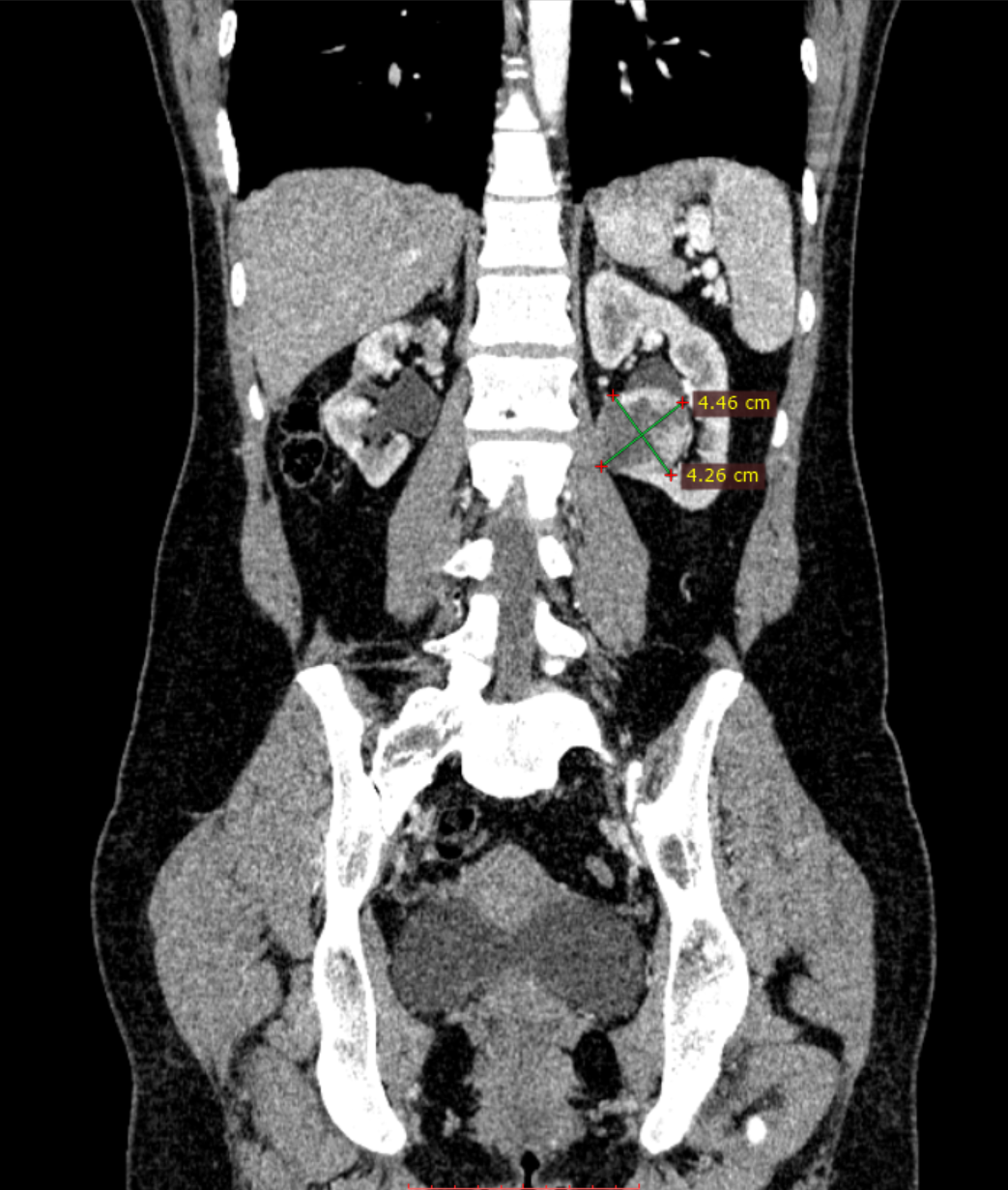 Operacja laparoskopowego usunięcia gua nerki w 13 tyg. ciąży