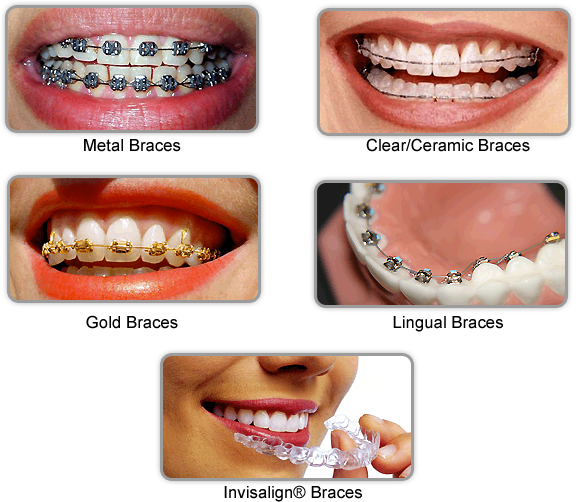 Cosmetic dentistry in bangalore Invisalign braces bangalore