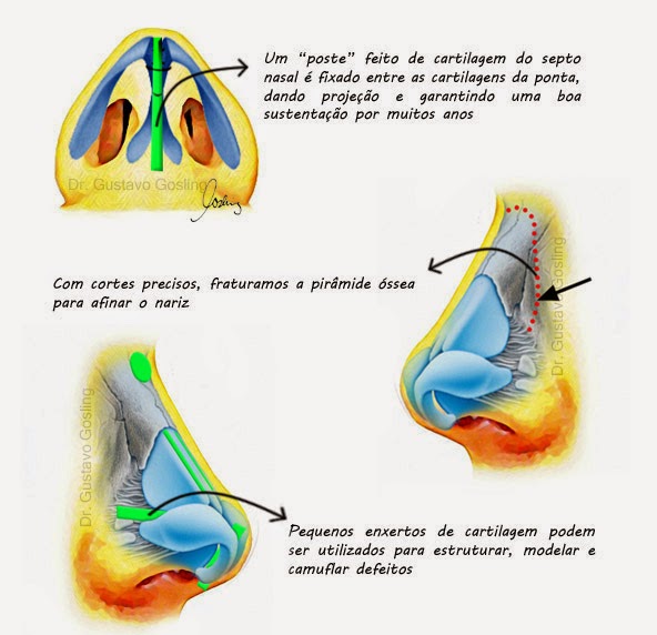 Rinoplastia porque sim!: • Rinoplastia aberta, fechada e outras técnicas