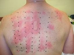 allergy patch tests food