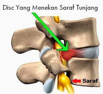 Apa Itu Herniated Disc - Apa Itu?