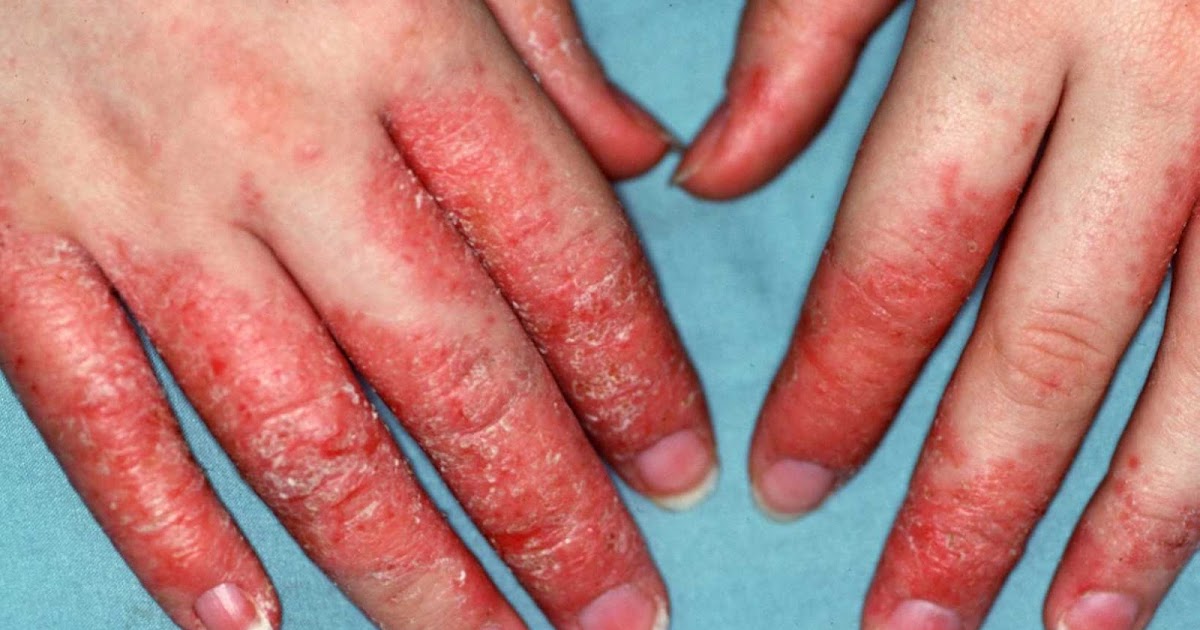 Health Care Information ENZEMA ON HANDS