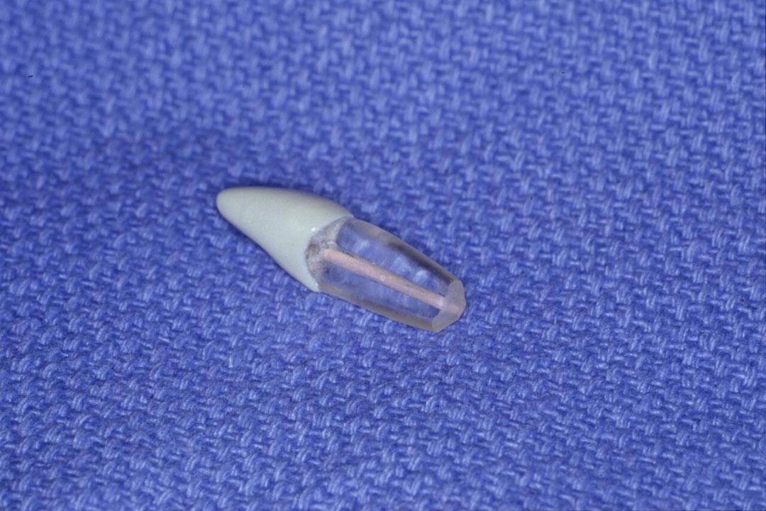 Dentistry Custom Cast Dowel Core