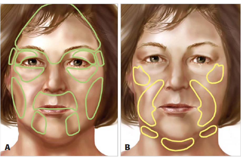 plastic and reconstructive surgery facial fat grafting how to facial fat