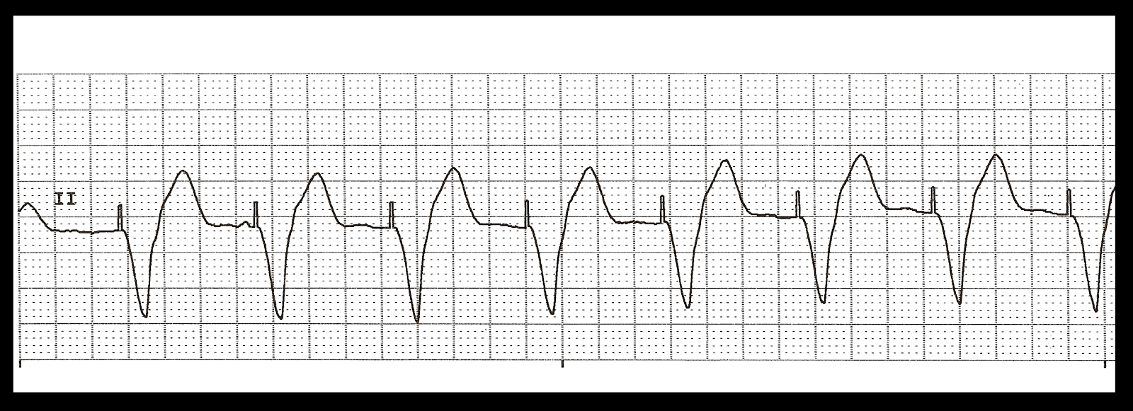 typical atrial flutter icd 10