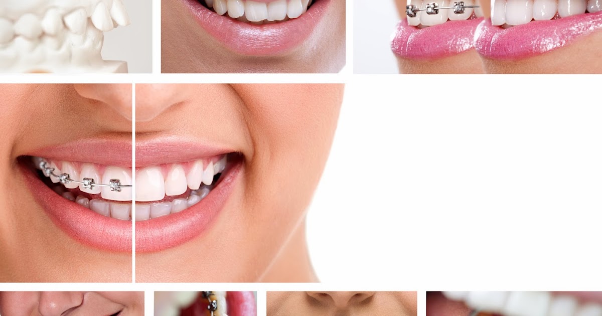 Diamond Braces Braces Behind Teeth A Little Secret That No One Has To