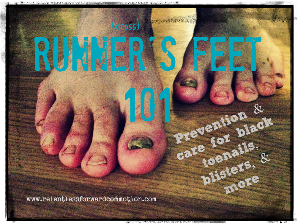 Runner’s Feet 101 Black Toenails, Blisters, & more.
