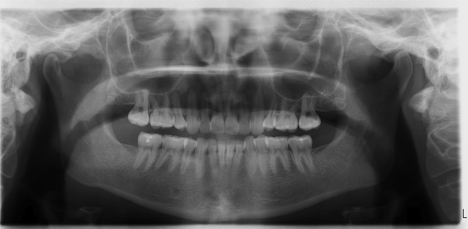 orthodontics for orthognathic surgery Orthodontist gainsville ga invisalign braces | sosebee and britt orthodontics orthodontist-gainesville-oakwood-sosebee & britt orthodontics-orthognathic-surgery. orthodontics for orthognathic surgery Orthodontist gainsville ga invisalign braces | sosebee and britt orthodontics orthodontist-gainesville-oakwood-sosebee & britt orthodontics-orthognathic-surgery.