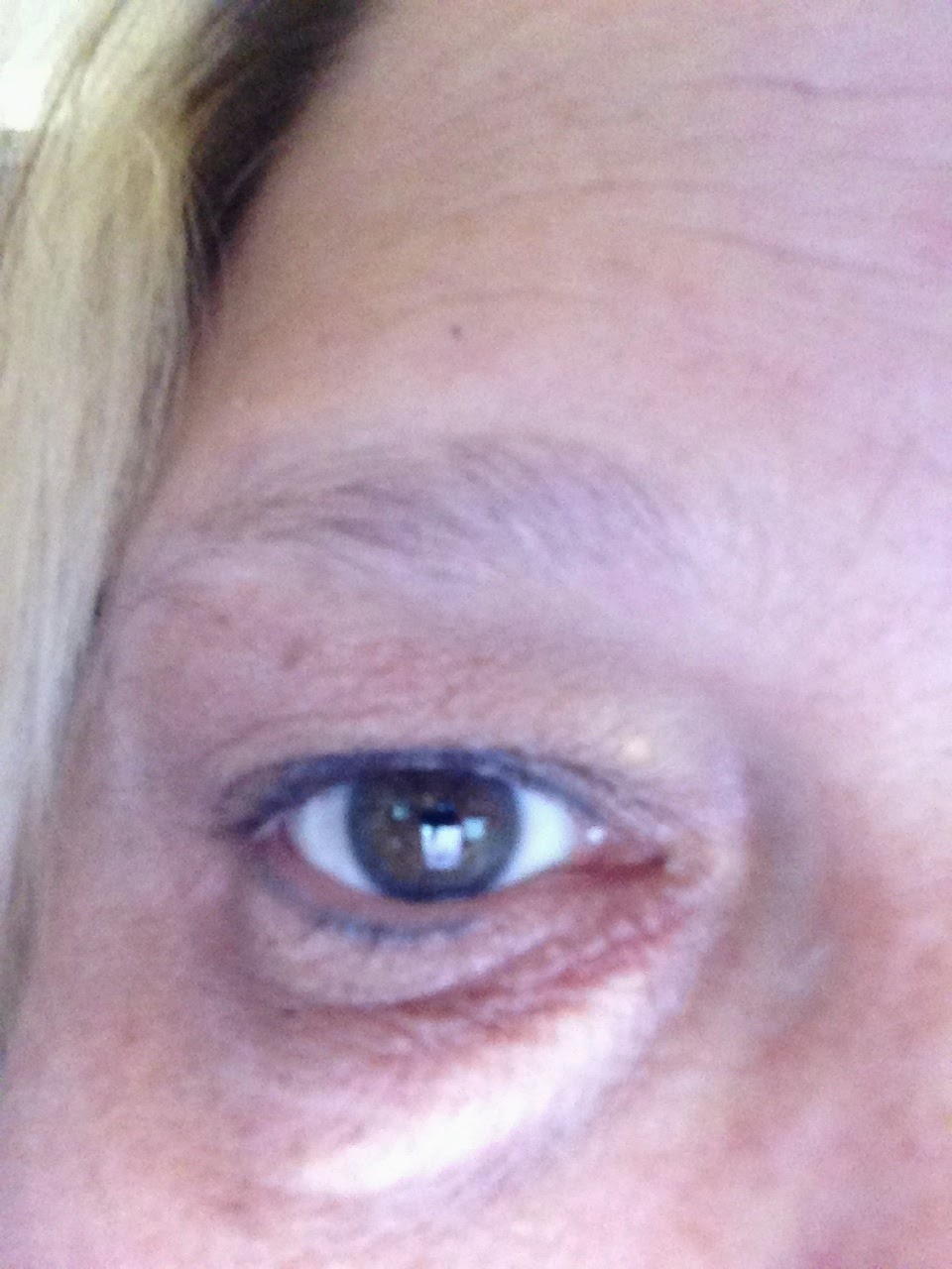 xanthelasma treatment with garlic