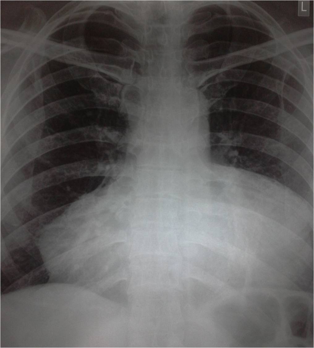 Pericarditis X Ray