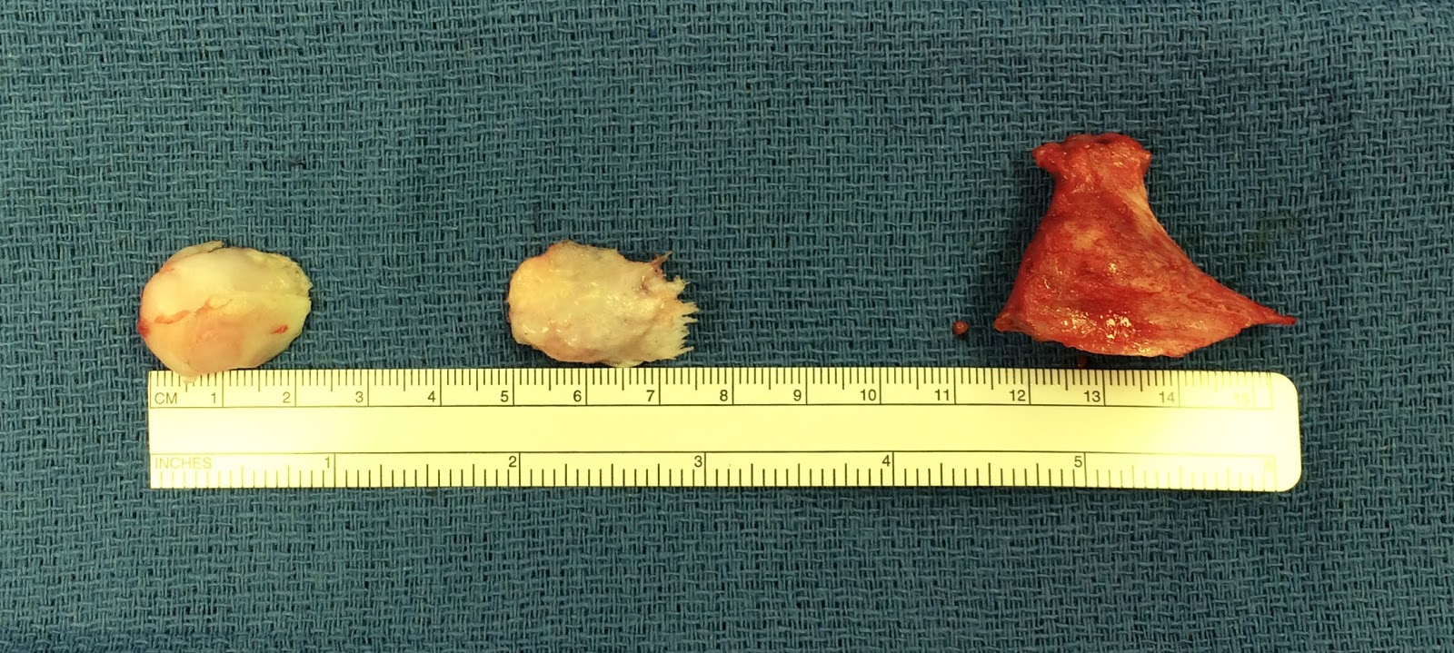 Young Adult with Multiple Hereditary Exostoses Congenital Hand and