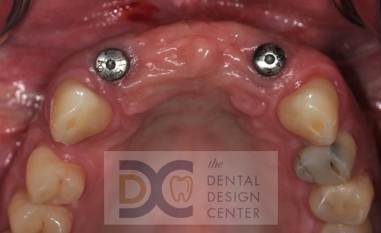 dental%2Bimplant%2Bpattaya%2Bdentist%2Bclinic