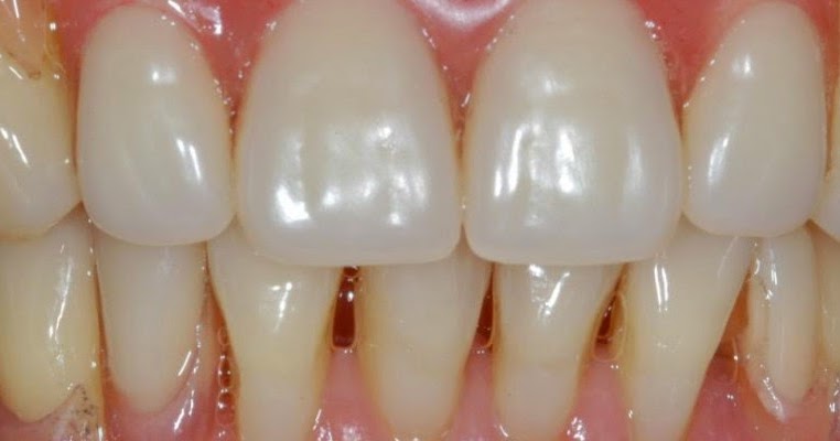 Diş eti çekilmesi nedir? Diş eti çekilmesi nedenleri? Diş eti çekilmesi