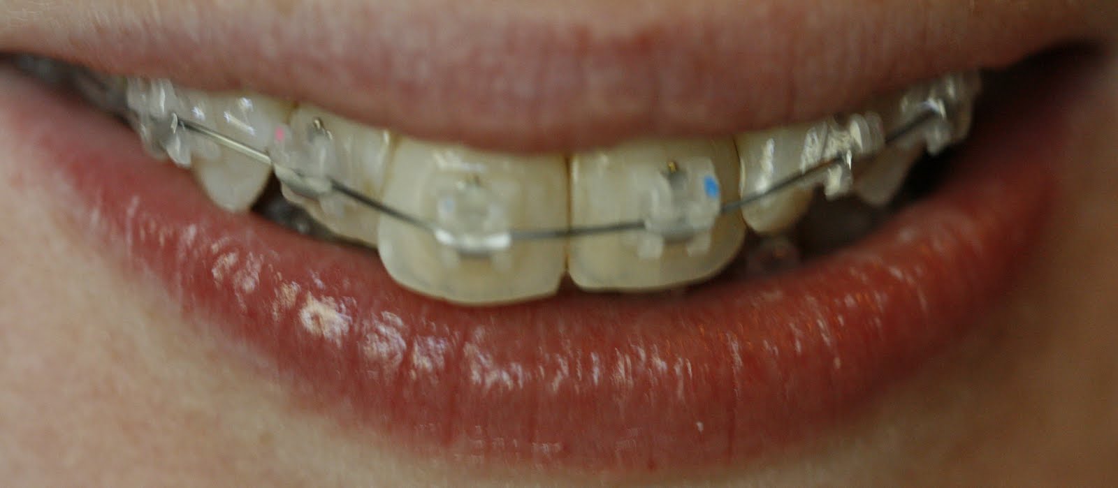 A 29 year old's braces diary... Braces )