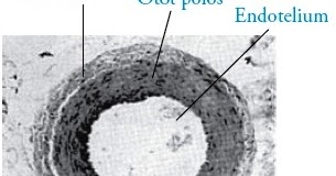 Penyebab Penyakit Jantung Koroner