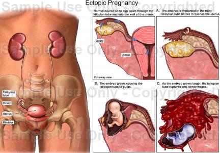 Ectopic Pregnancy - Beyond, Symptoms, Risk - Outside Gynecologist Diagnose ... Ectopic Pregnancy - Beyond, Symptoms, Risk - Outside Gynecologist Diagnose ...
