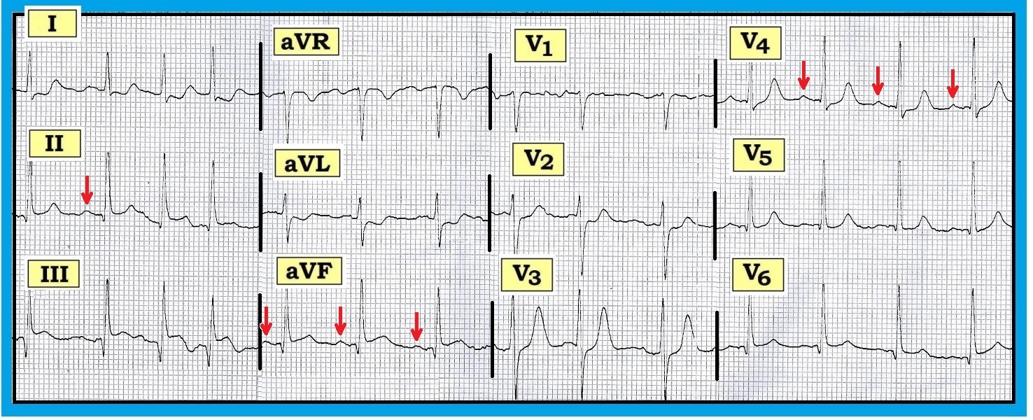 ECG Interpretation May 2012