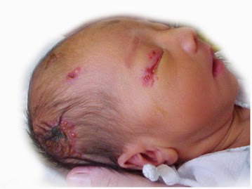 Penyakit Herpes Bayi