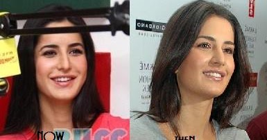 Katrina Kaif before and after plastic surgery |Alia Bhatt