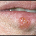Balanite:causes,symptômes,traitement et remèdes naturels Balanite:causes,symptômes,traitement et remèdes naturels
